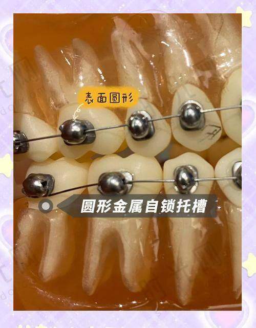 4. 整牙是隐形的好还是钢牙好?比“速度”:谁能更快变整齐?