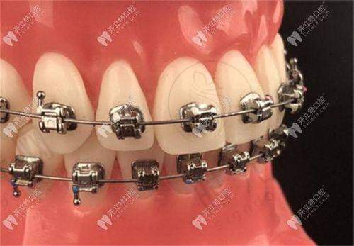 1. 整牙是隐形的好还是钢牙好?职场人:选隐形,容貌即“职场名片”