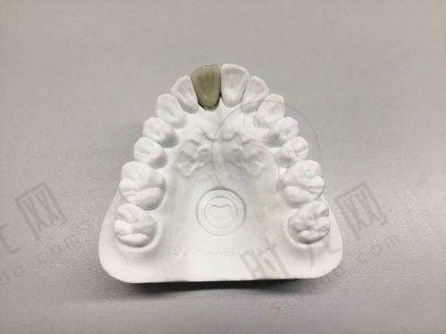 总结:牙齿松动要不要拔掉?记住这3句话