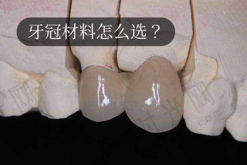 二、国产全瓷牙和进口全瓷牙怎么选？2025年性价比之王是这3个品牌！