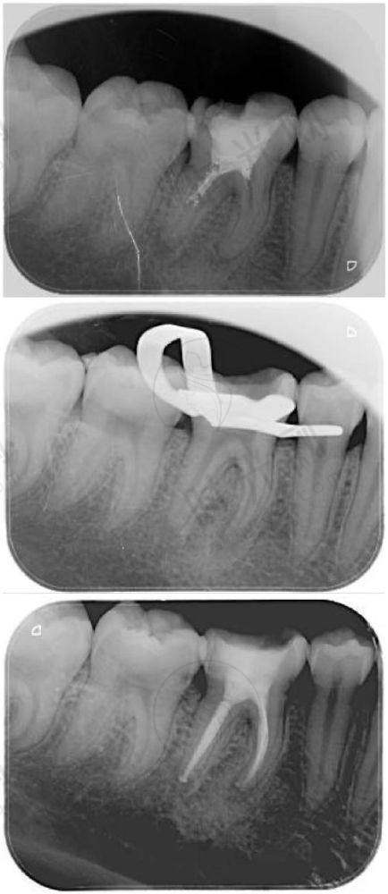 ? 集采补贴:四川、安徽等地种植牙价格“腰斩”!