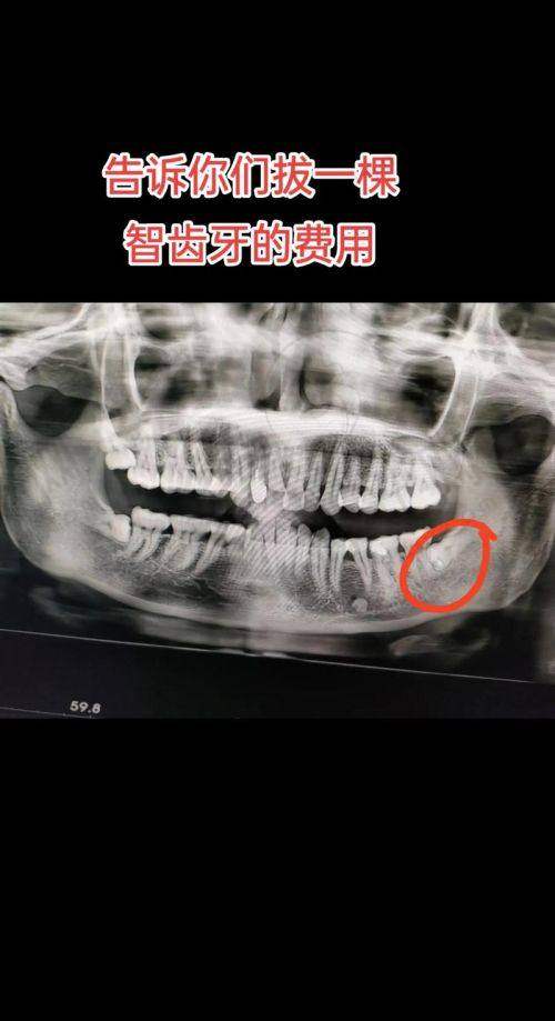 五、2025横生智齿拔除价格表：国有医院VS私立医院怎么选？（附报销攻略）