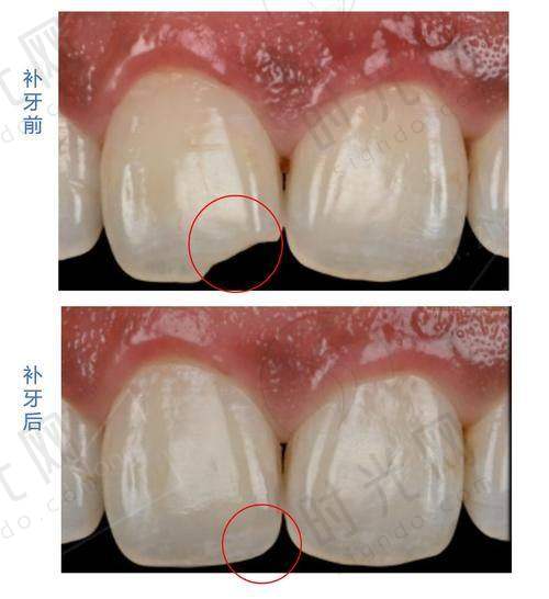 ? 拔智齿别踩这3个坑！选机构、做检查、术后护理，每步都有讲究
