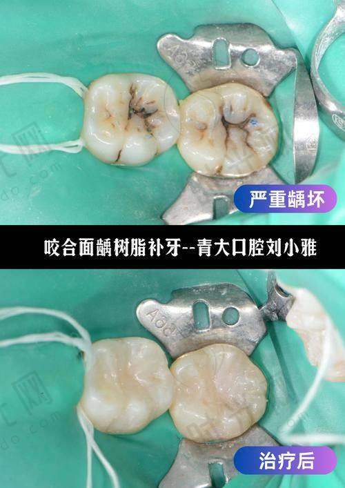二、不同人群牙齿松动的危险信号：别等“晃得厉害”才重视！