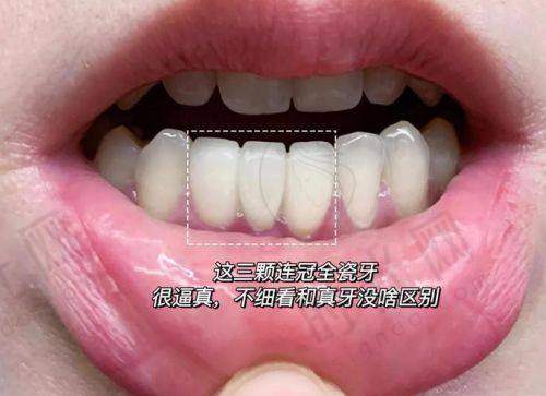 六、怎么选？适合做美国3M拉瓦全瓷牙的3类人群