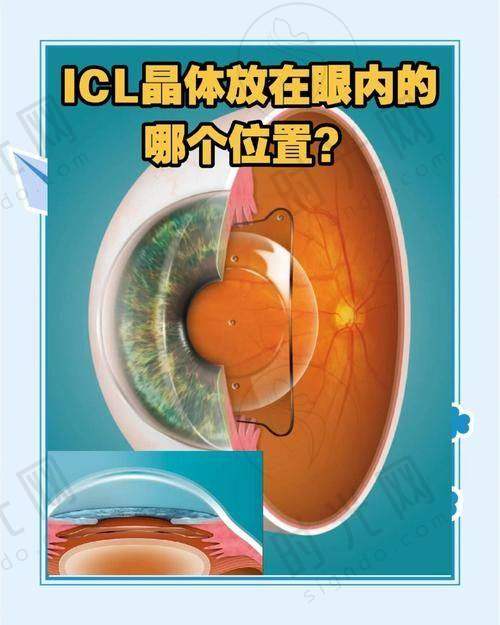 近视手术价格一览表：不同人群手术方案及预算建议