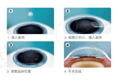 近视手术价格一览表：术前必看的省钱攻略