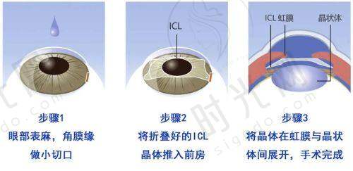 读者提问：“预算1万5，我该选半飞秒还是全飞秒？”