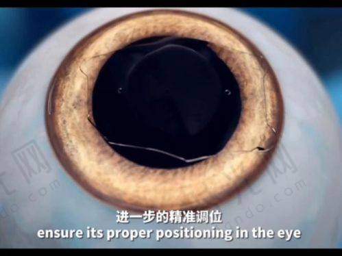 眼睛视力矫正手术多少钱：地区价差背后的秘密