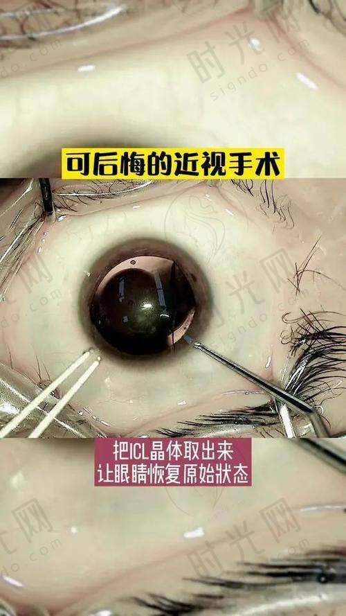 近视手术哪种更安心？全飞秒vs半飞秒vs ICL核心差异对比