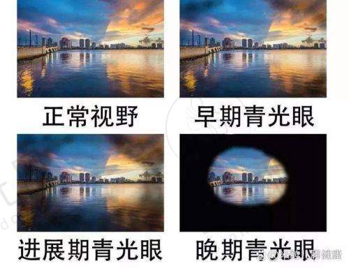 白内障多焦晶体,单焦晶体怎么选:60岁/70岁推荐方案,结合生活习惯选才不后悔