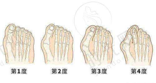 阴道紧缩针的成效及维持时间