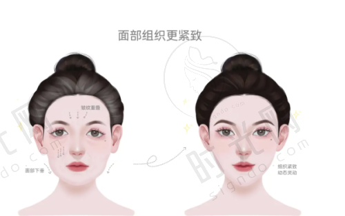 不同价格阴道紧缩针的区别