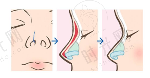 医美机构预约阴道紧缩针的注意事项