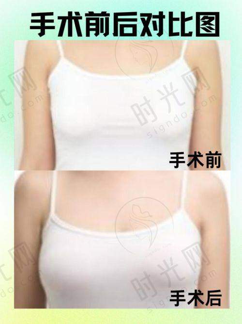 总结：想做隆胸的姐妹们选沈阳隆胸医院排名的3个核心提醒