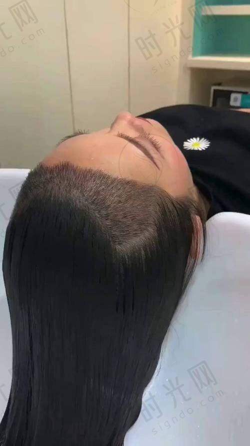 植发术前术后避坑指南