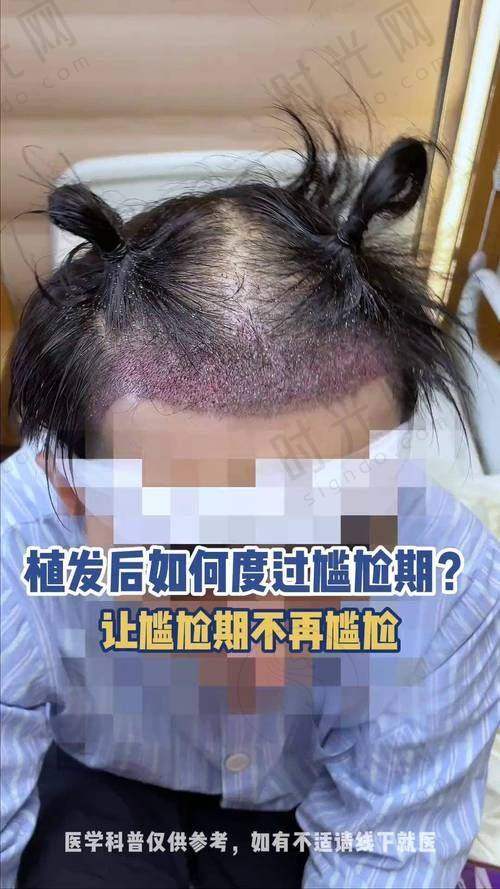重庆万州植发机构价格表
