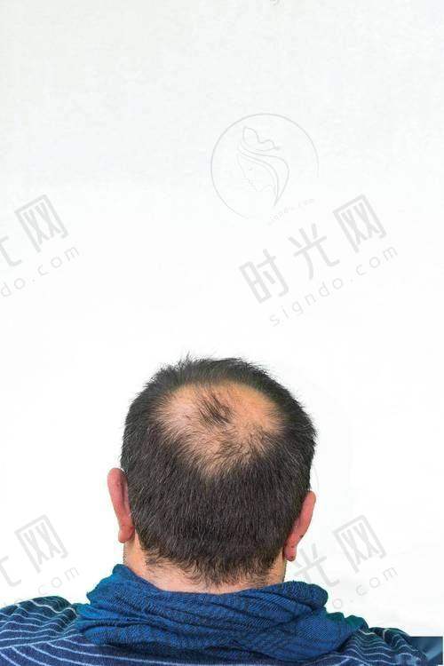 重庆万州植发机构靠谱医生信息