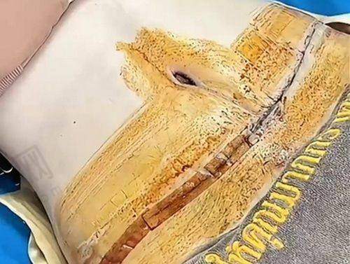 上海星璨李海涛筋膜大拉皮预约方式及贴心提示