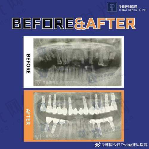 种牙韩系和欧系区别：昆明竹子口腔医院真实优势展现
