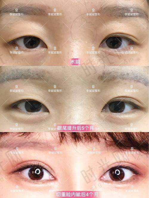 郑州眼袋修复王杨医生怎么预约挂号