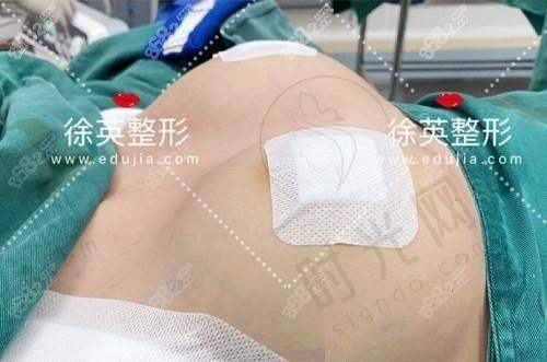 实例3：全肋鼻综合 + 面部填充，打造“妈生感”轮廓