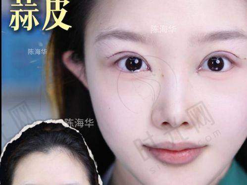 实例2：眼袋修复 + 卧蚕再造