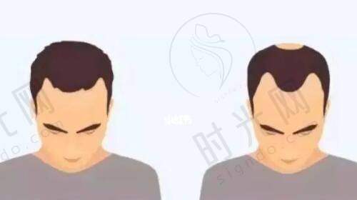 二次手术间隔时间：为什么有的患者需要3个月？