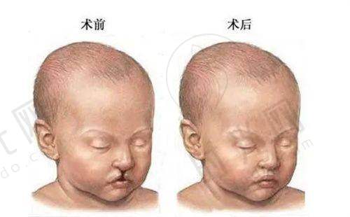 5D微孔弧矫正术：上海骨科医生如何用“微创技术”解决拇指翻不去？