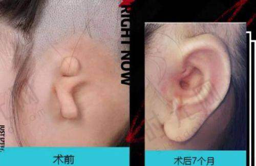 人中加深手术的风险大吗？3大常见并发症及避坑指南