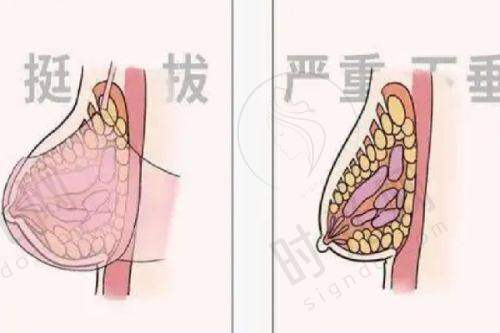 注射丰胸20年了有渗漏会怎样？