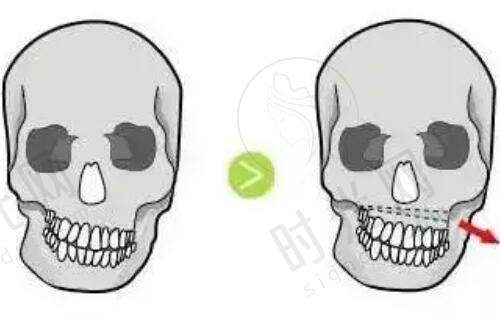 手指骨折握拳训练多久修复？从术后到正常活动的“黄金3阶段”时间表