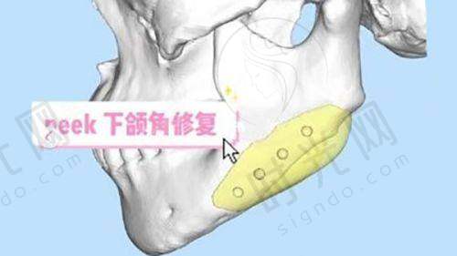 骨折后手指歪了能修复正常吗？——分3种情况看预后