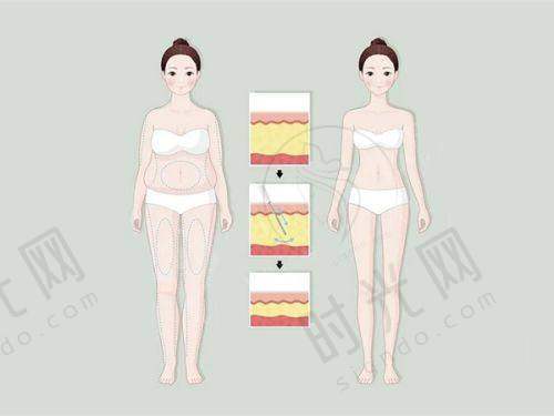 5D微孔弧矫正术治疗手部骨折拇指翻不去的修复时间表：多久能正常生活？