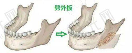 手指骨折二次手术术后修复怎么做？
