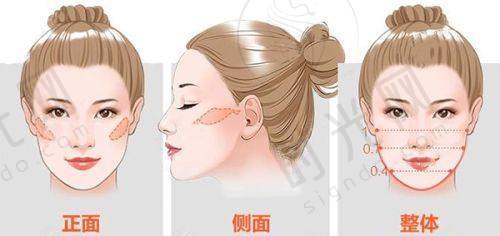 手指骨折二次手术是否可以评伤残？