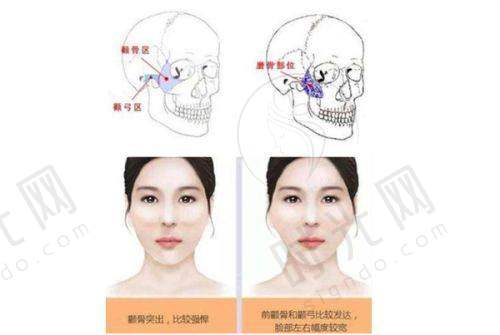 骨折手指再造3阶段修复周期：从伤口愈合到灵活抓握的关键节点