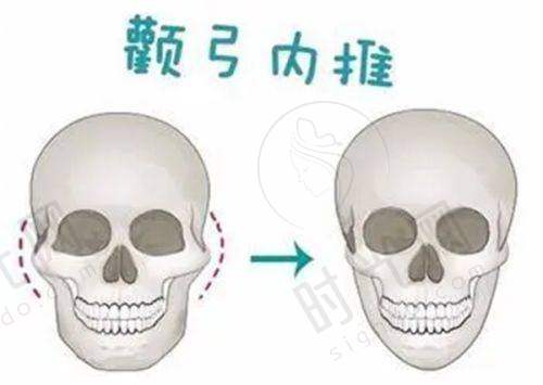 骨折后手指歪了怎么判断重度程度？——从3个维度自查