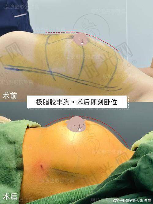 注射丰胸20年变大变硬内窥镜手术好吗？