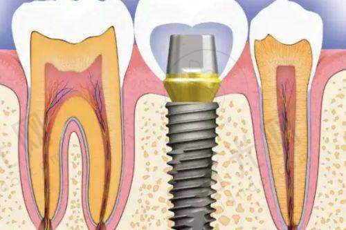 监利县人民医院牙科收费标准,监利中医院牙科价格按项目怎么选不踩雷