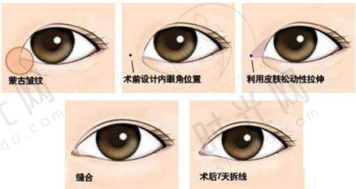 热门项目之隆鼻