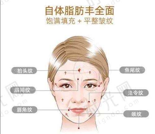 眼整形体验分享