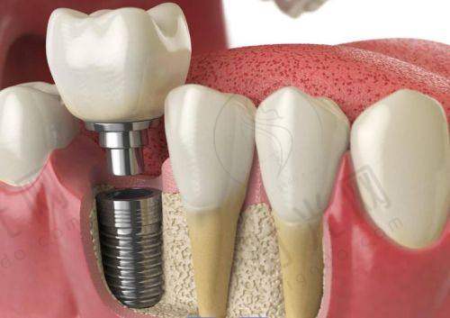 做昆明长鹏口腔项目的宝妈注意:术前术后避坑指南