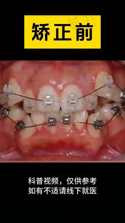 监利县人民医院牙科收费标准,监利中医院牙科价格真实实例