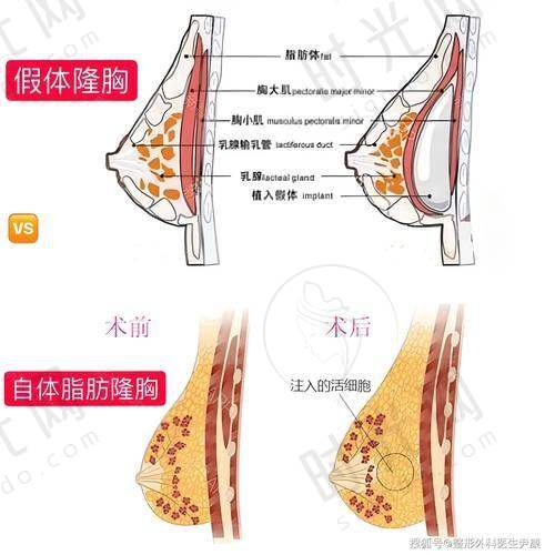 郭震宇自体脂肪丰胸价格表