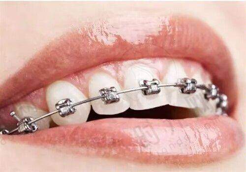 带娃矫正牙齿,呼和浩特牙科怎么挑?2025选对不踩坑