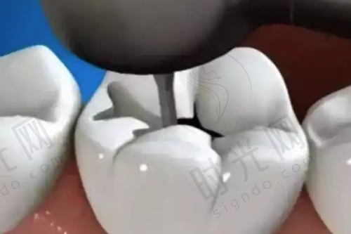 宁波鄞州德中口腔种牙真实实例分享