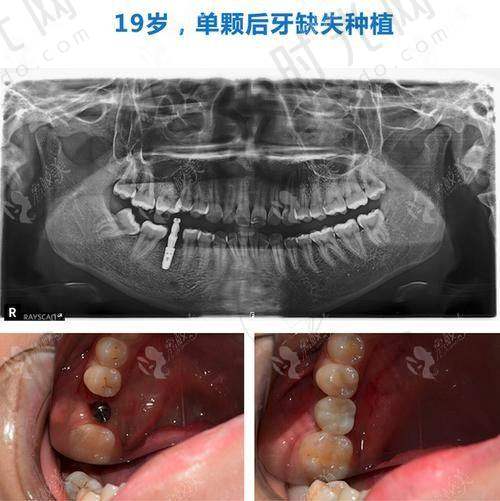 东莞健力口腔医院收费标准诚不欺人实例