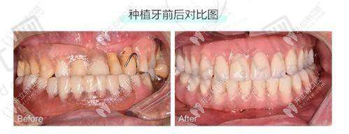 呼和浩特牙科常见认知误区大揭秘