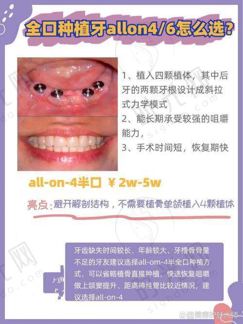 深圳宝安区种牙的决策要点